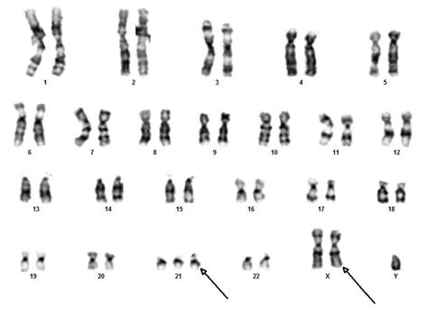 xxyy syndrome name|xxy syndrome female.